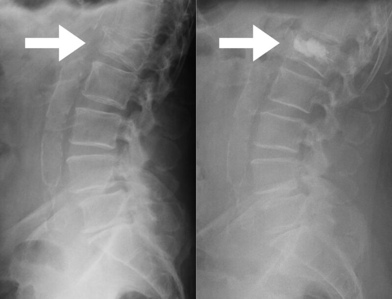 CIFOPLASTIA VERTEBROPLASTIA - Cifoplastía