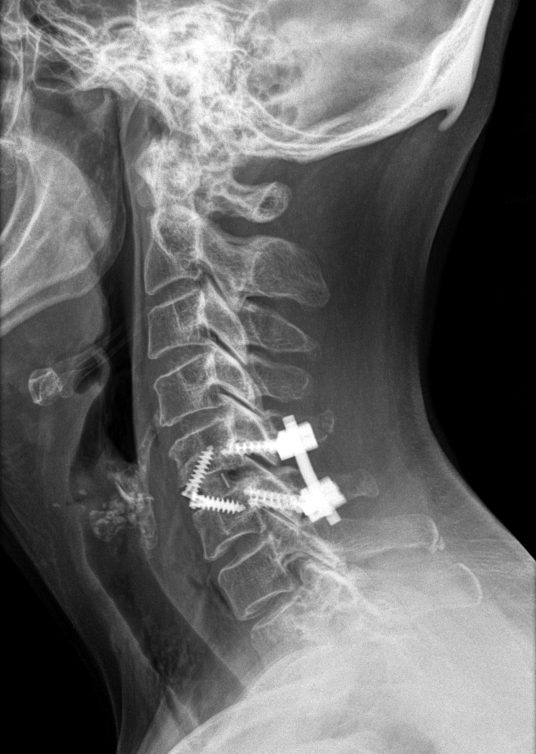 CIRUGIA DE COLUMNA CERVICAL 1 - Cirugía de columna cervical