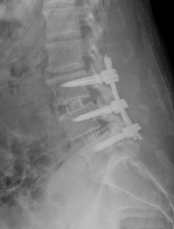 CIRUGIA PERCUTANEA POSTERIOR 1 - Cirugía percutánea posterior