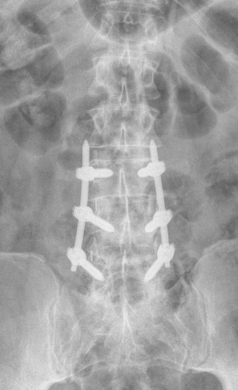 CIRUGIA PERCUTANEA POSTERIOR - Cirugía percutánea posterior