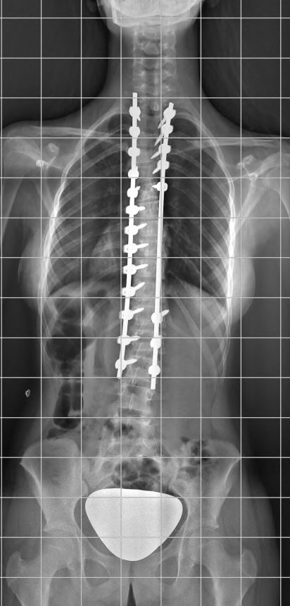 CORRECCION DE ESCOLIOSIS 1 - Corrección de escoliosis