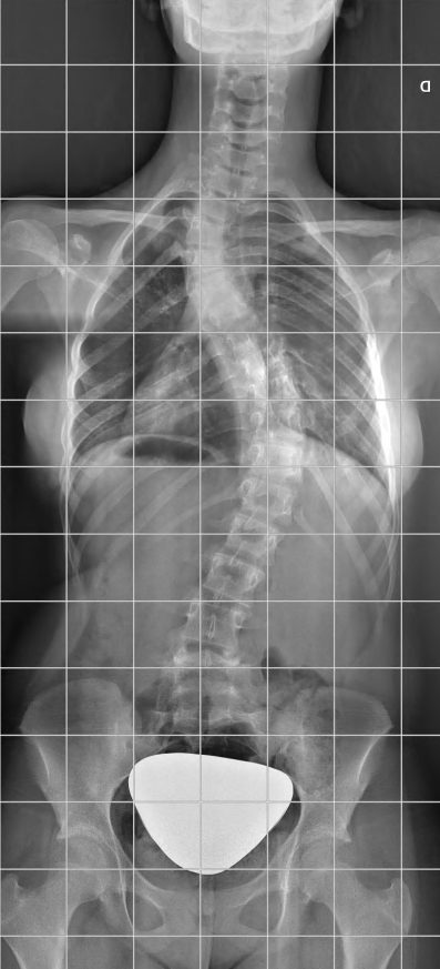 CORRECCION DE ESCOLIOSIS - Corrección de escoliosis